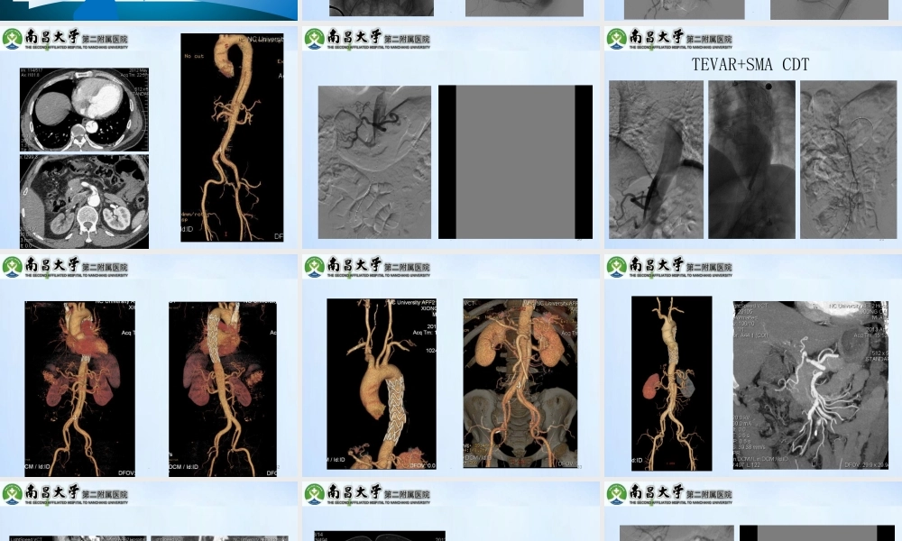 累及内脏动脉的型主动脉夹层的处理精选文档PPT课件