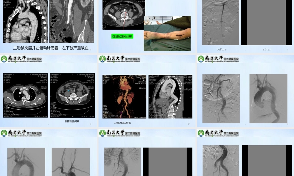 累及内脏动脉的型主动脉夹层的处理精选文档PPT课件
